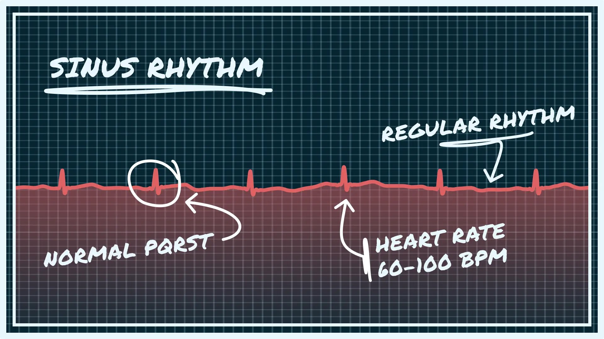 What Sinus Rhythm Looks Like on Your Watch ECG Qaly